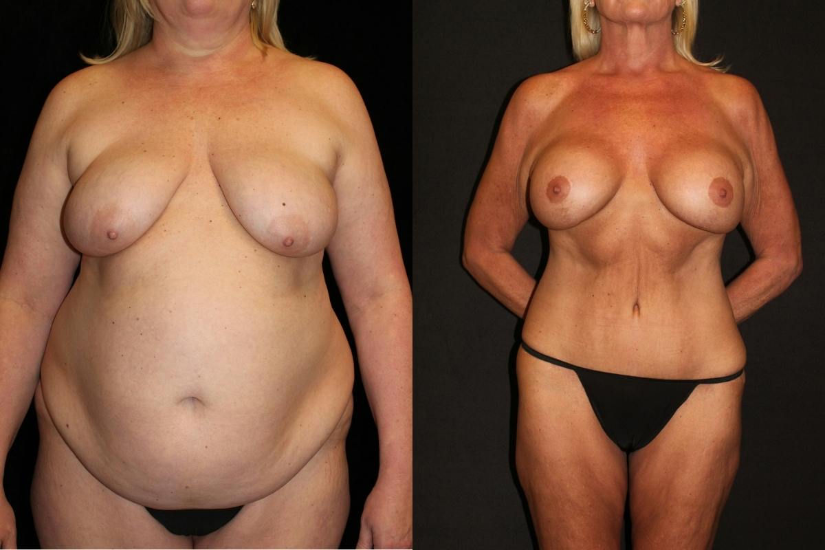 Body Lift Before & After Gallery - Patient 173452 - Image 1