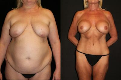 Body Lift Before & After Gallery - Patient 173452 - Image 1