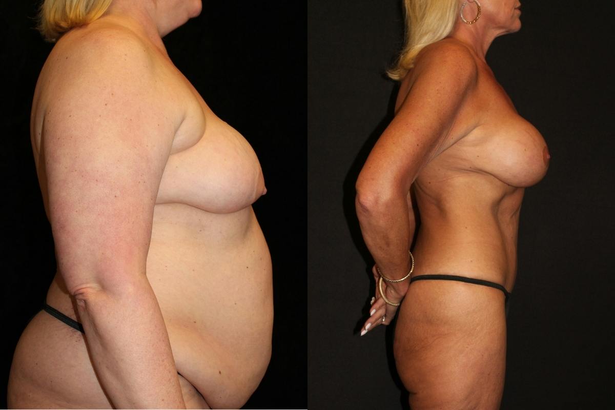 Body Lift Before & After Gallery - Patient 173452 - Image 3