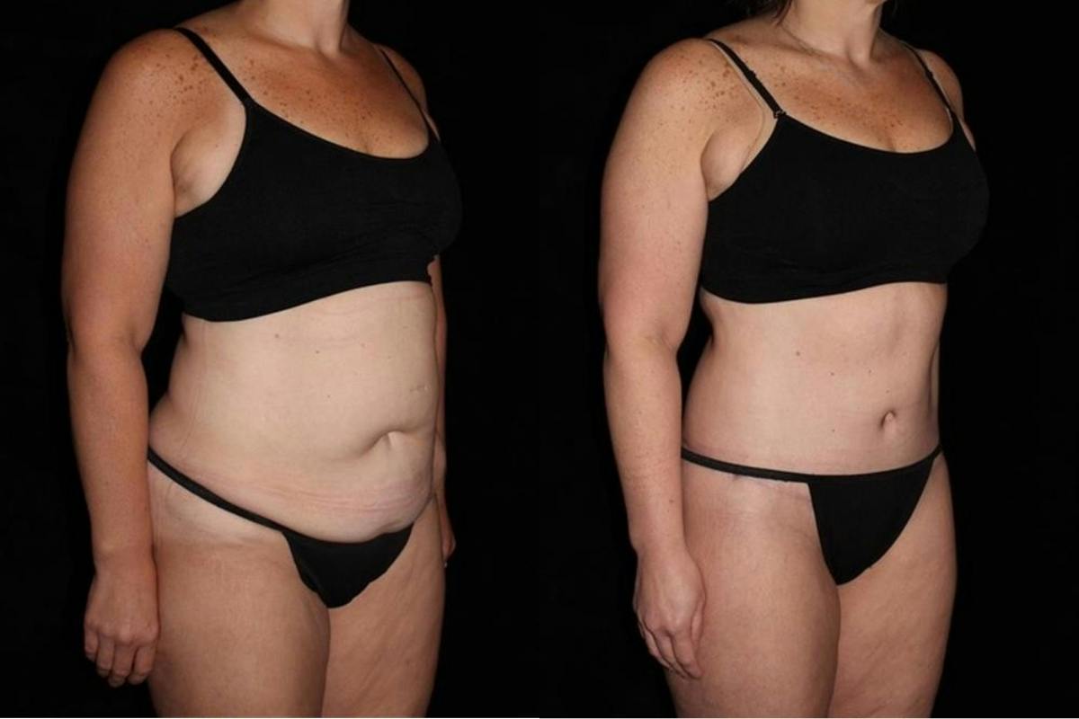 Body Lift Before & After Gallery - Patient 160172 - Image 2
