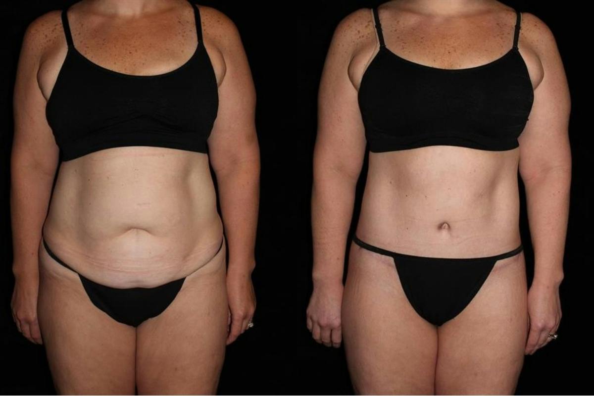 Body Lift Before & After Gallery - Patient 160172 - Image 1