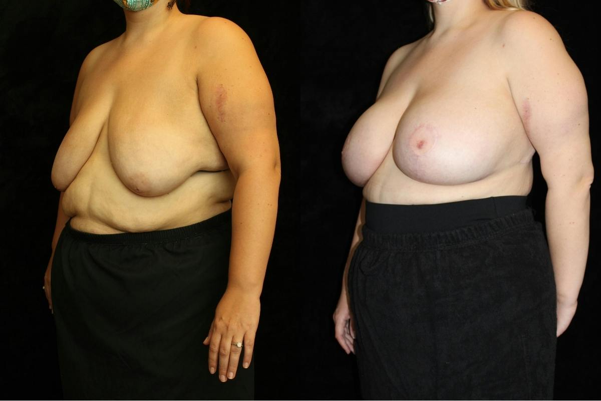 Body Lift Before & After Gallery - Patient 345124 - Image 2