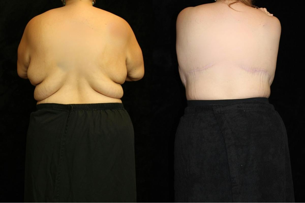 Body Lift Before & After Gallery - Patient 345124 - Image 3