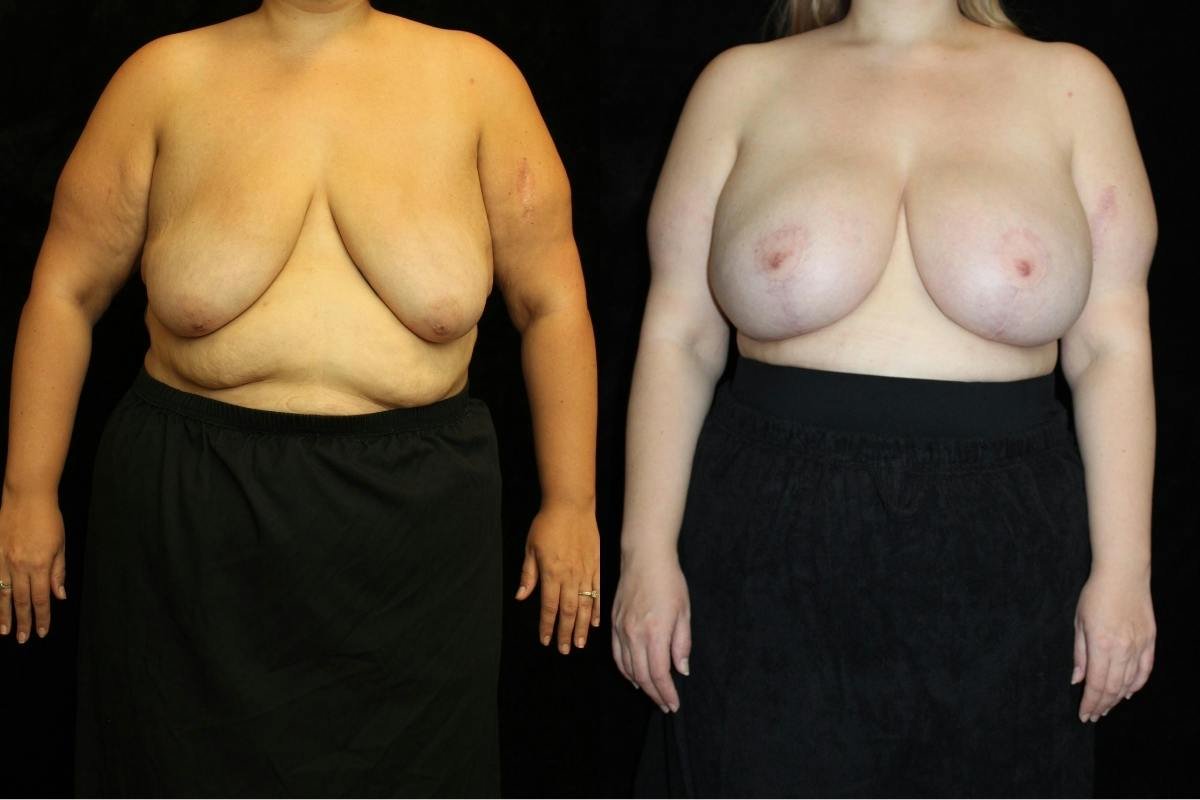 Body Lift Before & After Gallery - Patient 345124 - Image 1