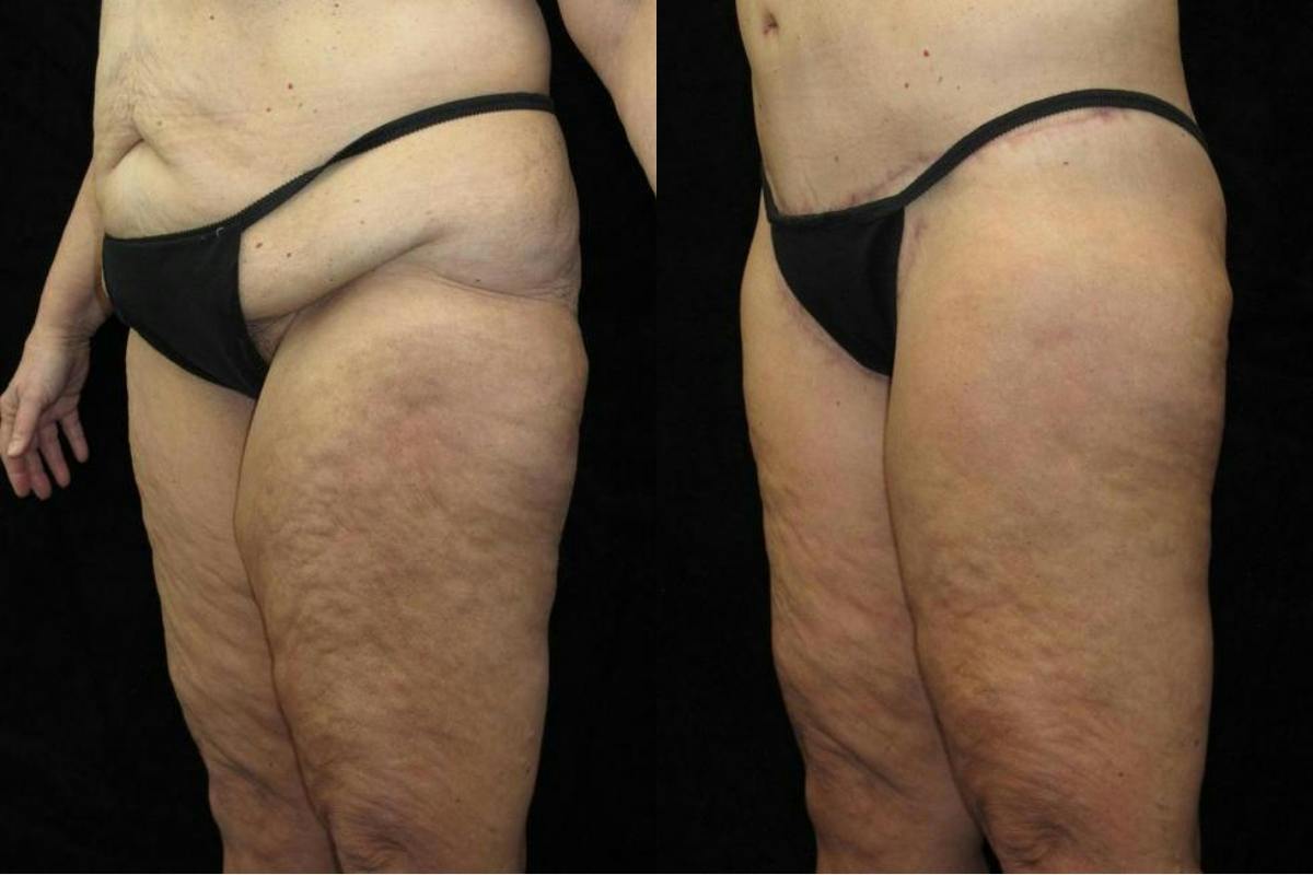 Body Lift Before & After Gallery - Patient 236961 - Image 2