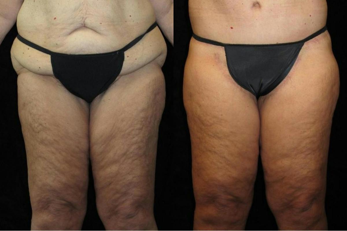 Body Lift Before & After Gallery - Patient 236961 - Image 4