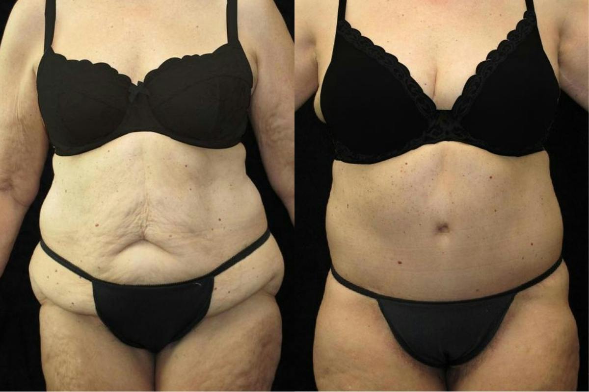Body Lift Before & After Gallery - Patient 236961 - Image 1