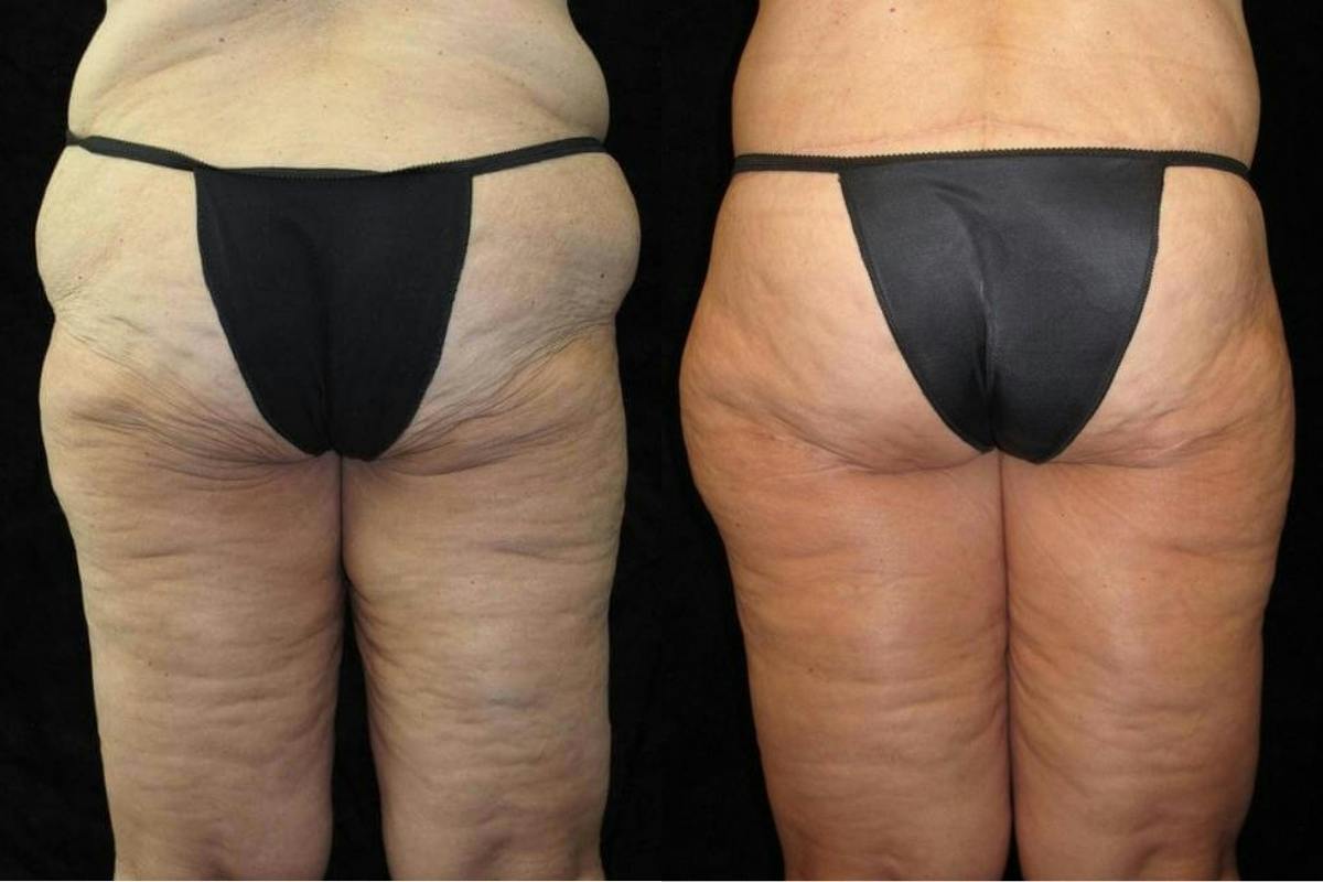 Body Lift Before & After Gallery - Patient 236961 - Image 5