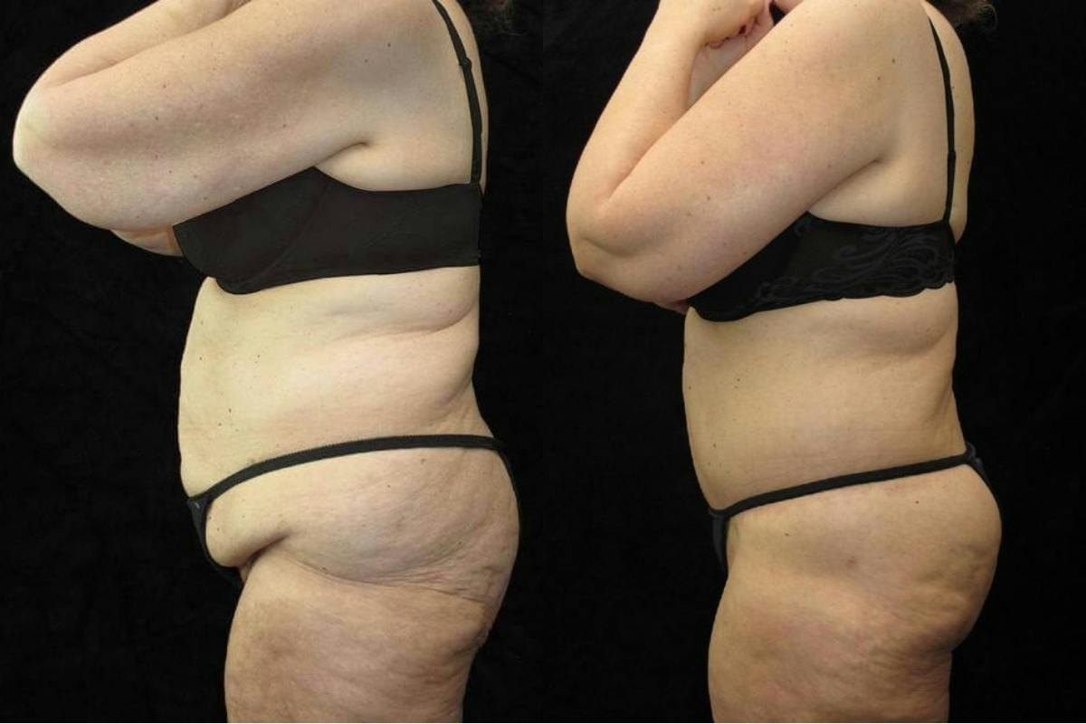 Body Lift Before & After Gallery - Patient 236961 - Image 3