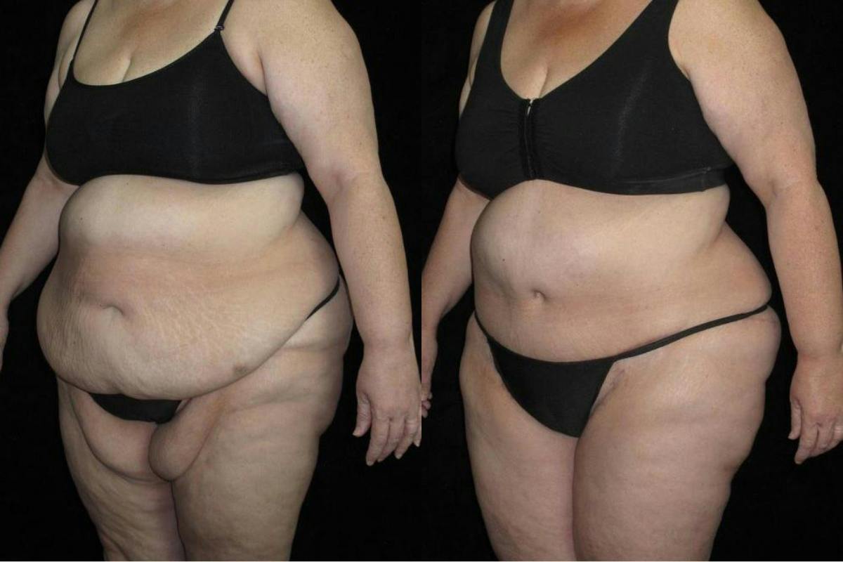 Body Lift Before & After Gallery - Patient 900774 - Image 2