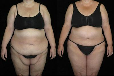 Body Lift Before & After Gallery - Patient 900774 - Image 1