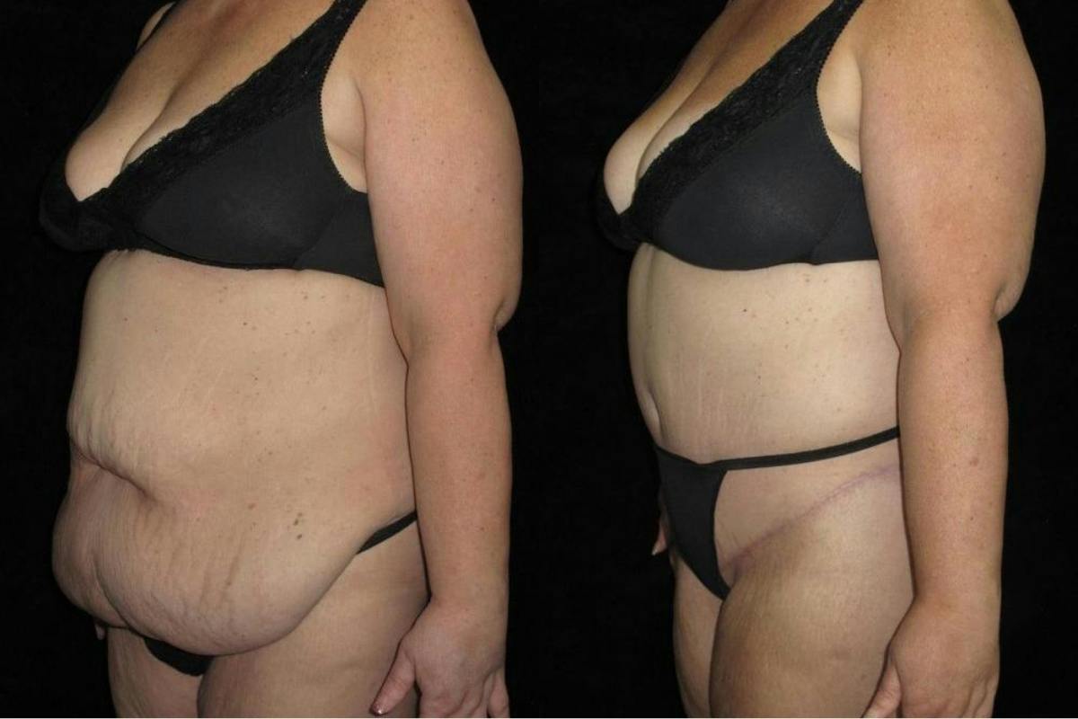 Body Lift Before & After Gallery - Patient 155016 - Image 2