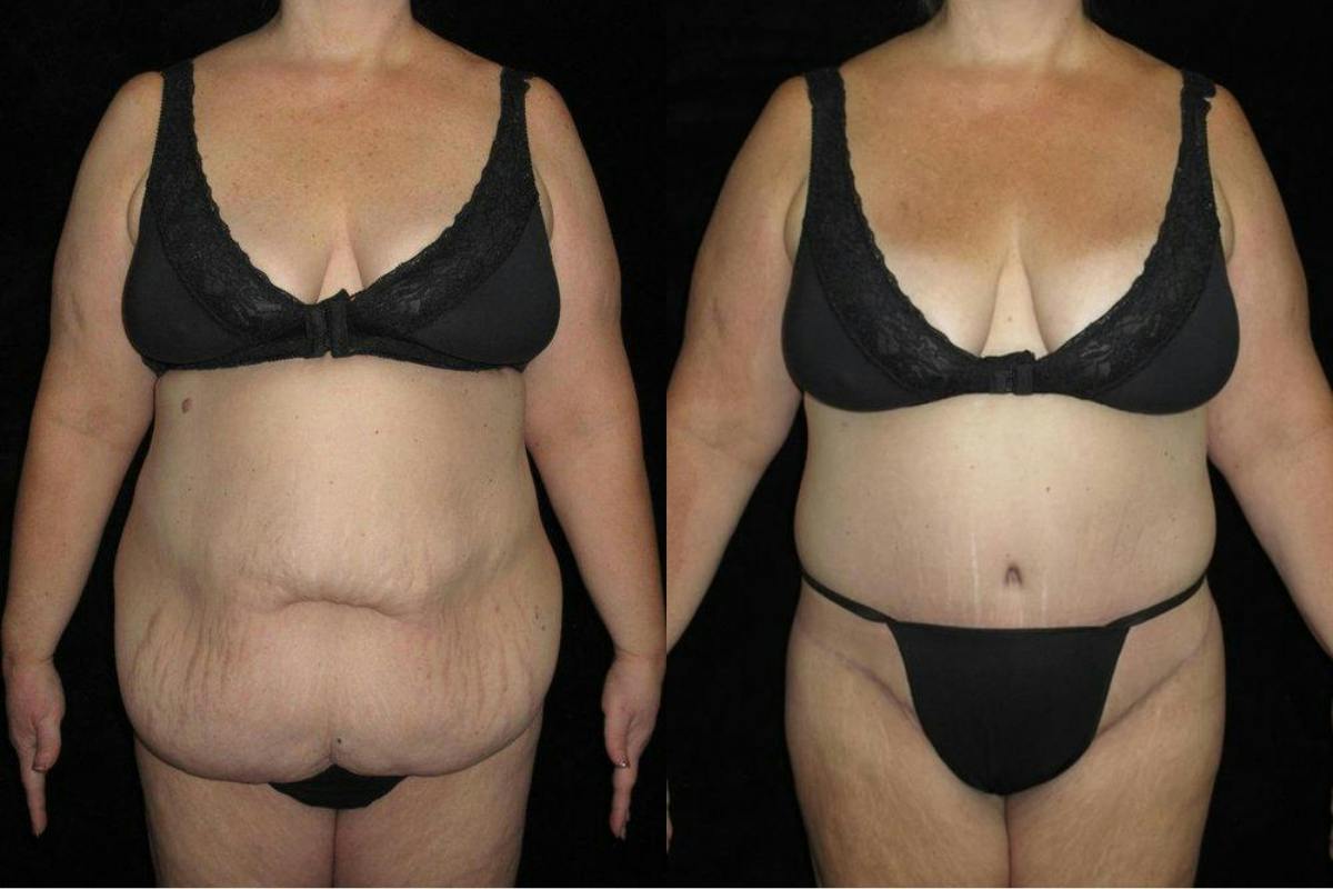 Body Lift Before & After Gallery - Patient 155016 - Image 1