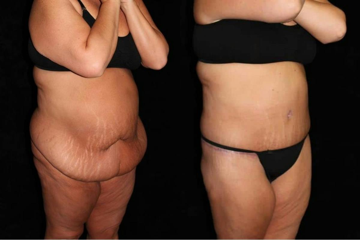 Body Lift Before & After Gallery - Patient 244066 - Image 2