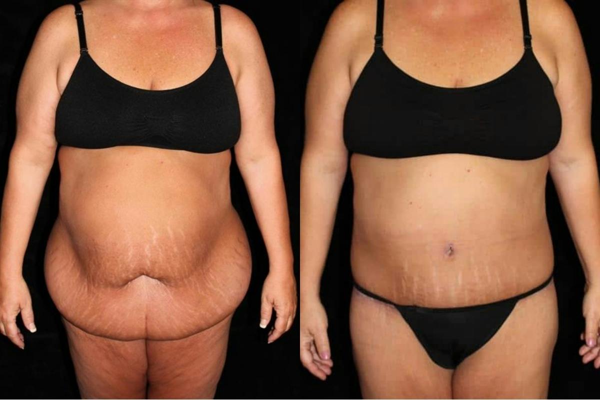 Body Lift Before & After Gallery - Patient 244066 - Image 1