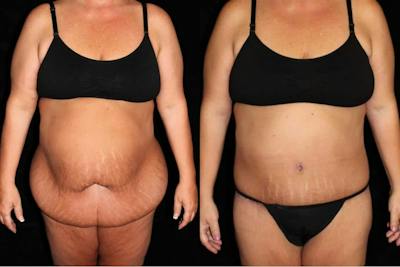 Body Lift Before & After Gallery - Patient 244066 - Image 1