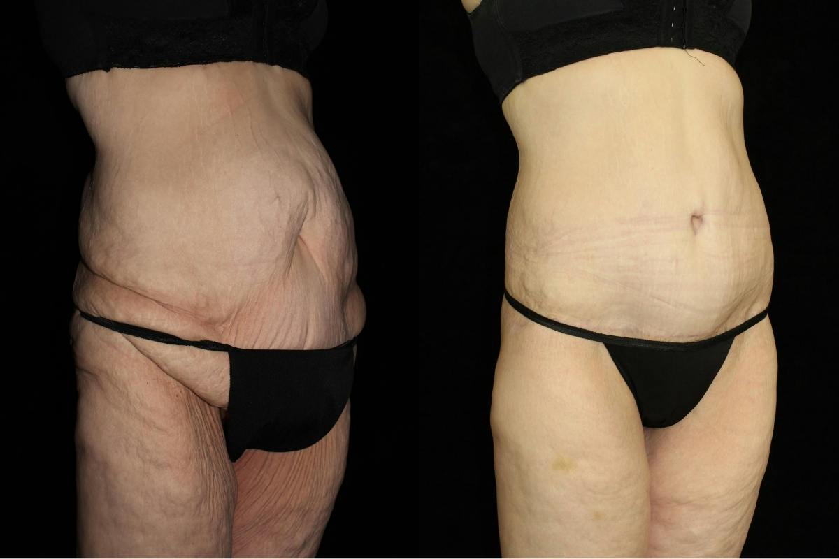 Body Lift Before & After Gallery - Patient 860501 - Image 2