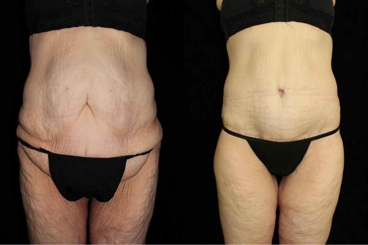 Body Lift Before & After Gallery - Patient 860501 - Image 1