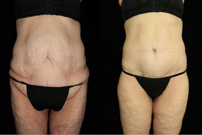Body Lift Before & After Gallery - Patient 860501 - Image 1
