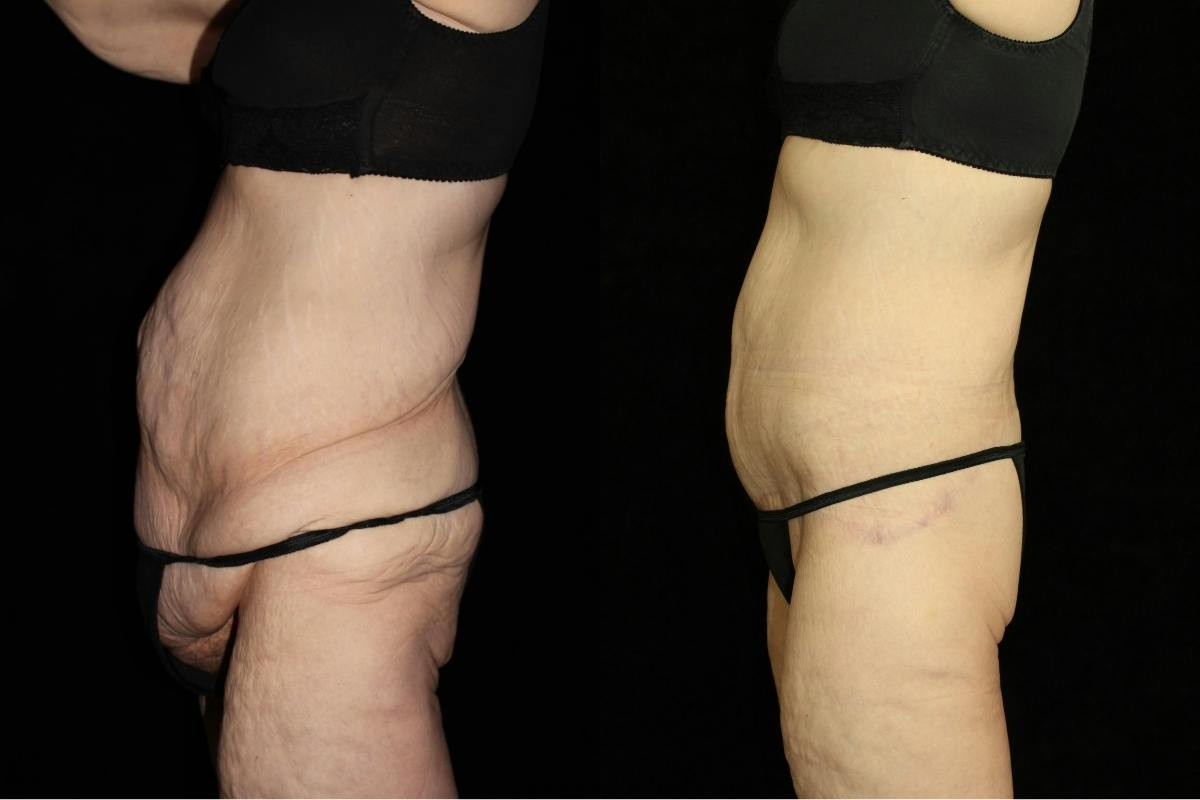 Body Lift Before & After Gallery - Patient 860501 - Image 3