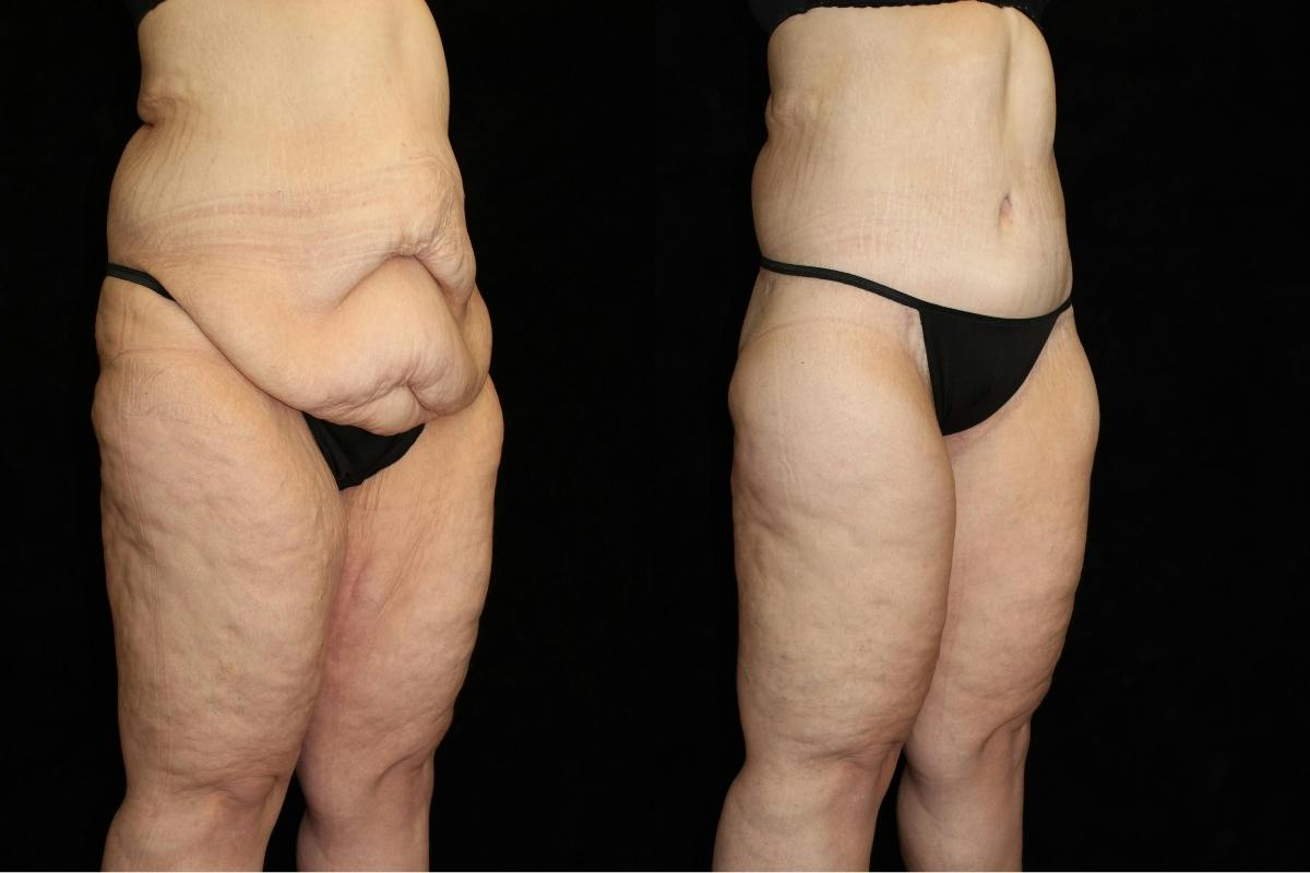 Body Lift Before & After Gallery - Patient 403384 - Image 2