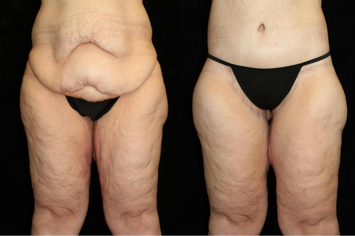 Body Lift Before & After Gallery - Patient 403384 - Image 1