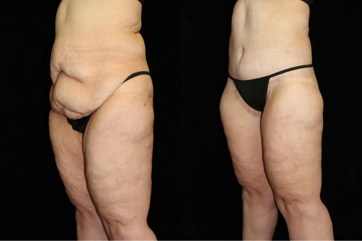 Body Lift Before & After Gallery - Patient 403384 - Image 3
