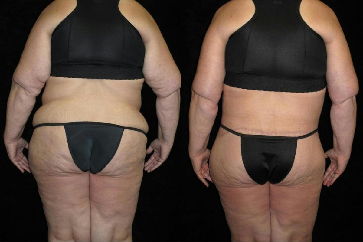 Body Lift Before & After Gallery - Patient 190388 - Image 3