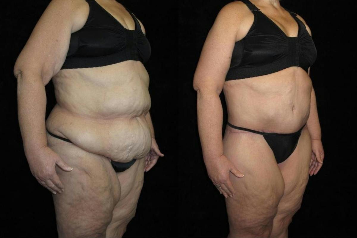 Body Lift Before & After Gallery - Patient 190388 - Image 2