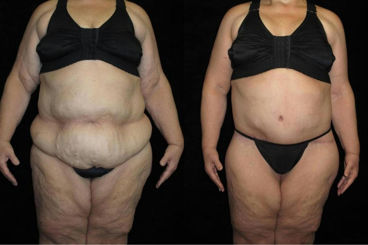 Body Lift Before & After Gallery - Patient 190388 - Image 1