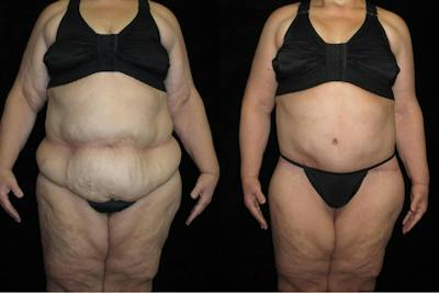 Body Lift Before & After Gallery - Patient 190388 - Image 1