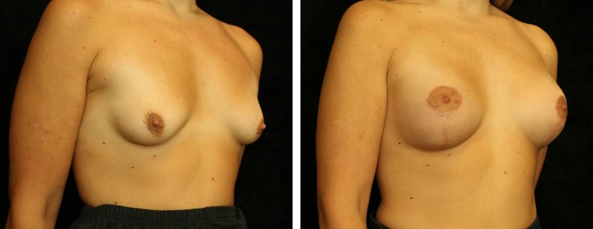 Breast Asymmetry Before & After Gallery - Patient 157621 - Image 2