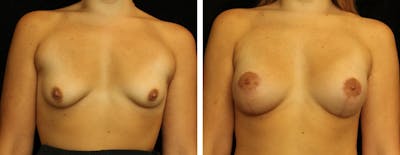 Breast Asymmetry Before & After Gallery - Patient 157621 - Image 1