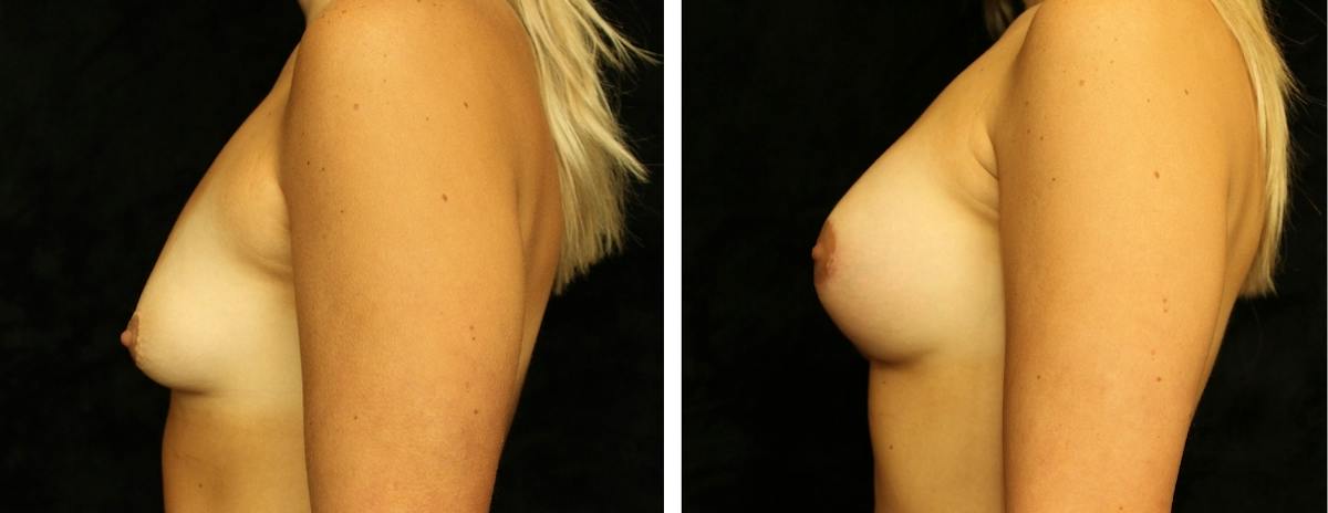 Breast Asymmetry Before & After Gallery - Patient 157621 - Image 3