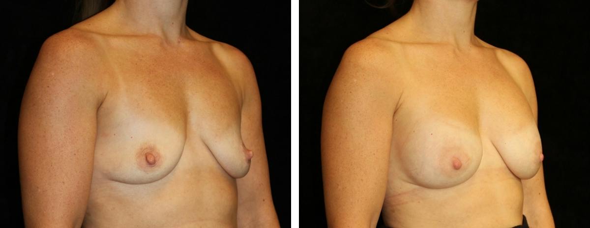 Breast Asymmetry Before & After Gallery - Patient 856218 - Image 2