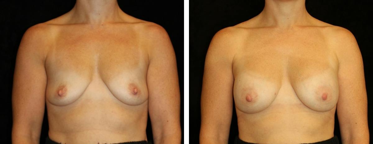 Breast Asymmetry Before & After Gallery - Patient 856218 - Image 1