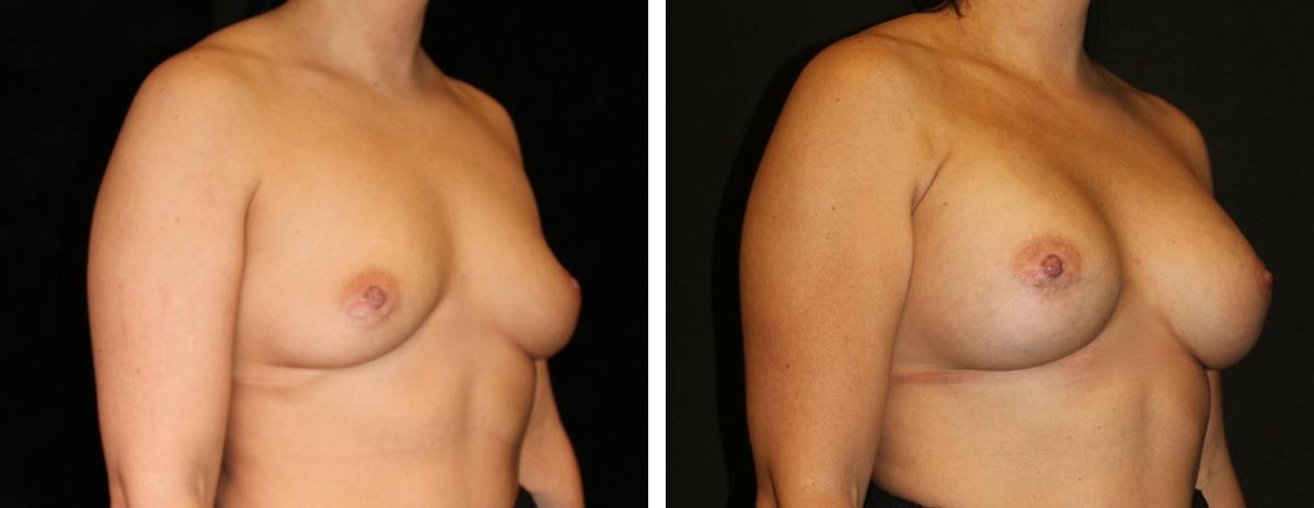 Breast Asymmetry Before & After Gallery - Patient 323208 - Image 2