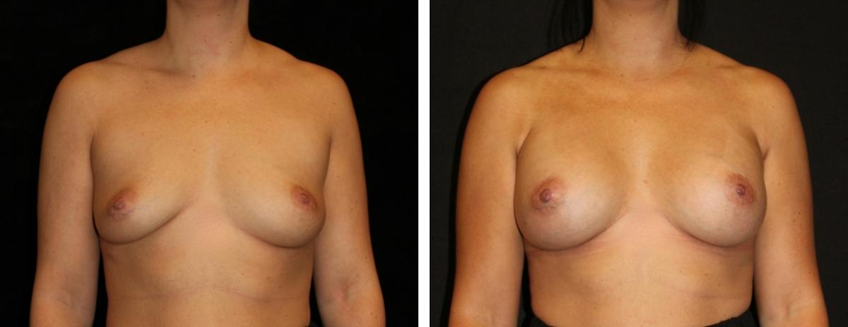 Breast Asymmetry Before & After Gallery - Patient 323208 - Image 1