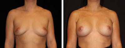 Breast Asymmetry Before & After Gallery - Patient 323208 - Image 1