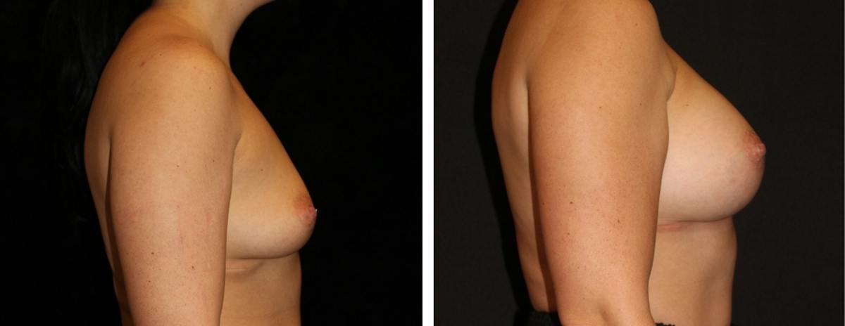Breast Asymmetry Before & After Gallery - Patient 323208 - Image 3