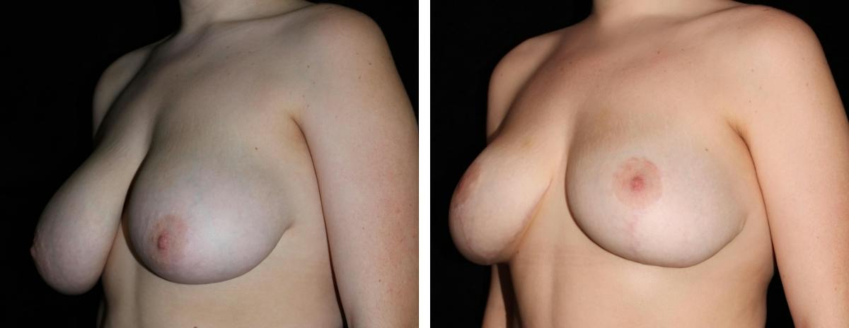 Breast Asymmetry Before & After Gallery - Patient 287097 - Image 2