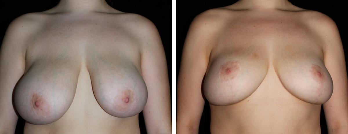 Breast Asymmetry Before & After Gallery - Patient 287097 - Image 1