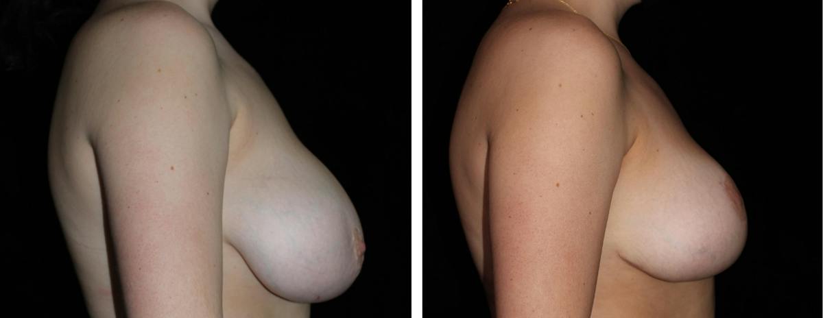 Breast Asymmetry Before & After Gallery - Patient 287097 - Image 3