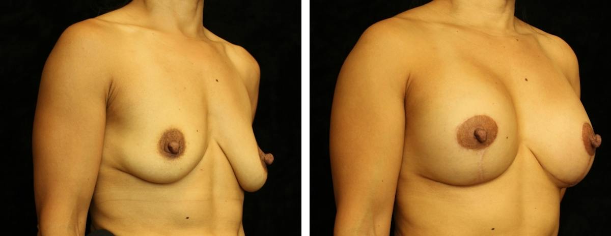 Breast Asymmetry Before & After Gallery - Patient 312601 - Image 2