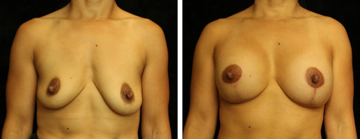 Breast Asymmetry Before & After Gallery - Patient 312601 - Image 1