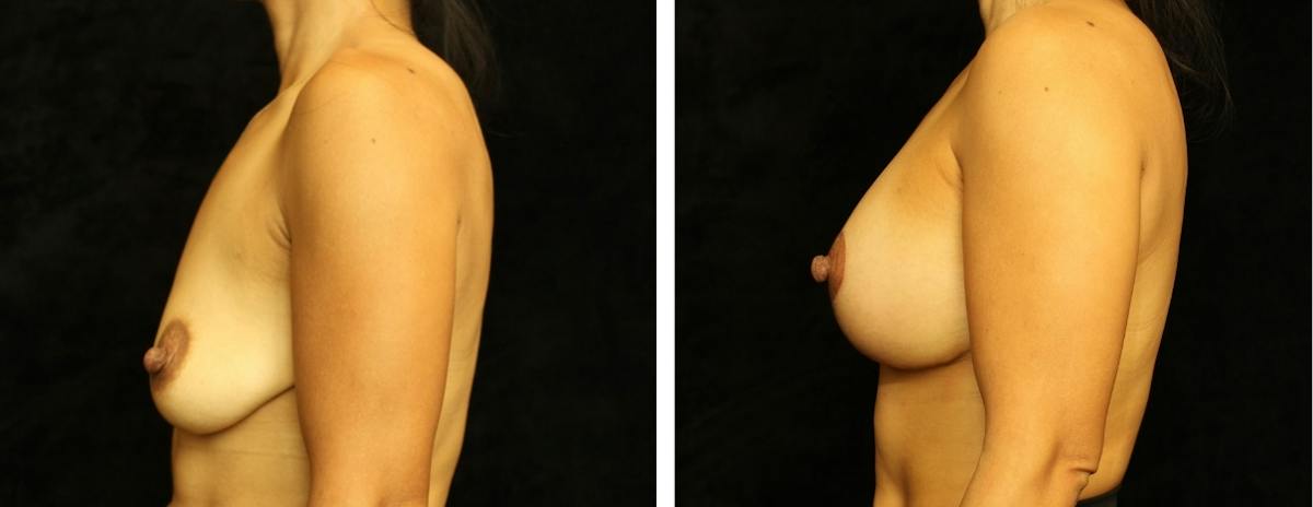 Breast Asymmetry Before & After Gallery - Patient 312601 - Image 3