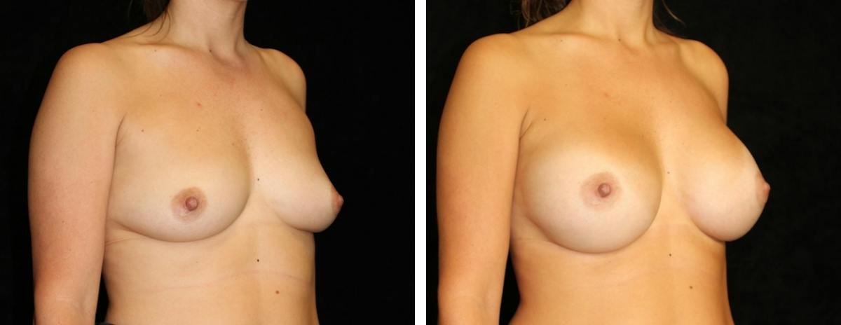 Breast Asymmetry Before & After Gallery - Patient 412048 - Image 2