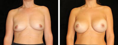 Breast Asymmetry Before & After Gallery - Patient 412048 - Image 1