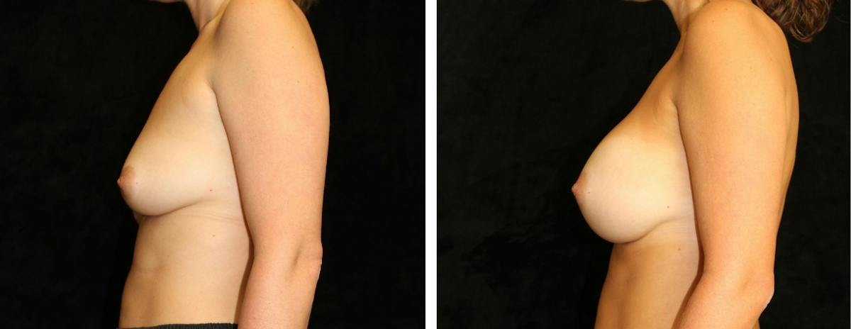 Breast Asymmetry Before & After Gallery - Patient 412048 - Image 3