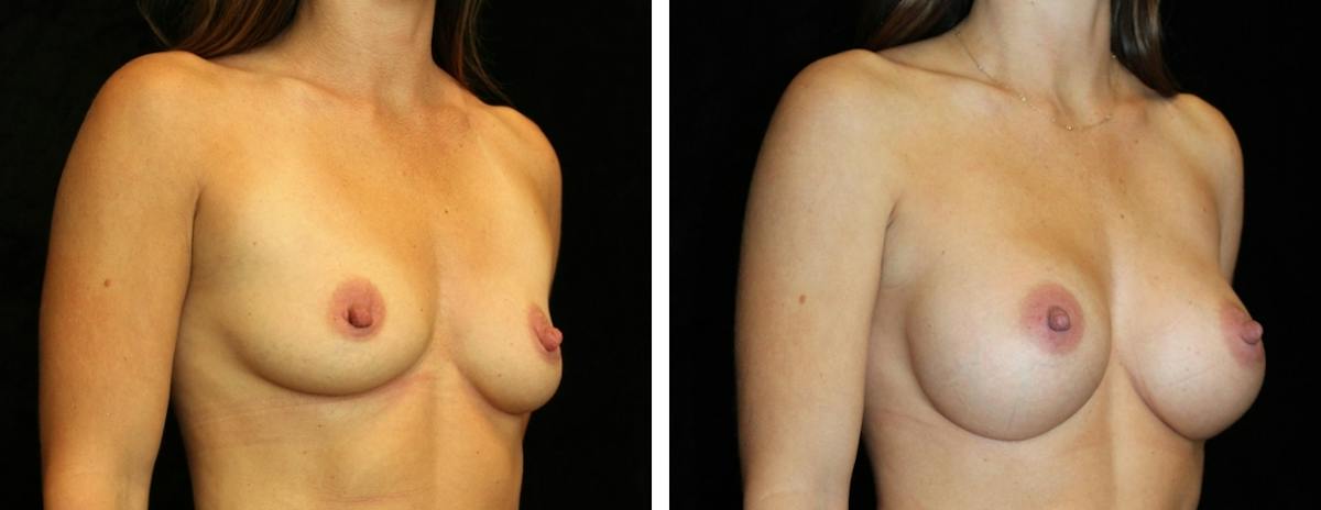 Breast Asymmetry Before & After Gallery - Patient 404156 - Image 2